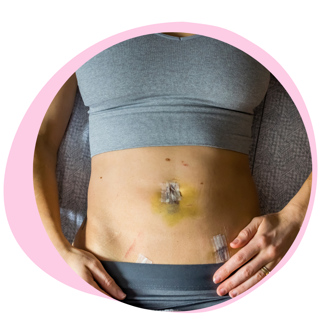 Endometriosis Surgery