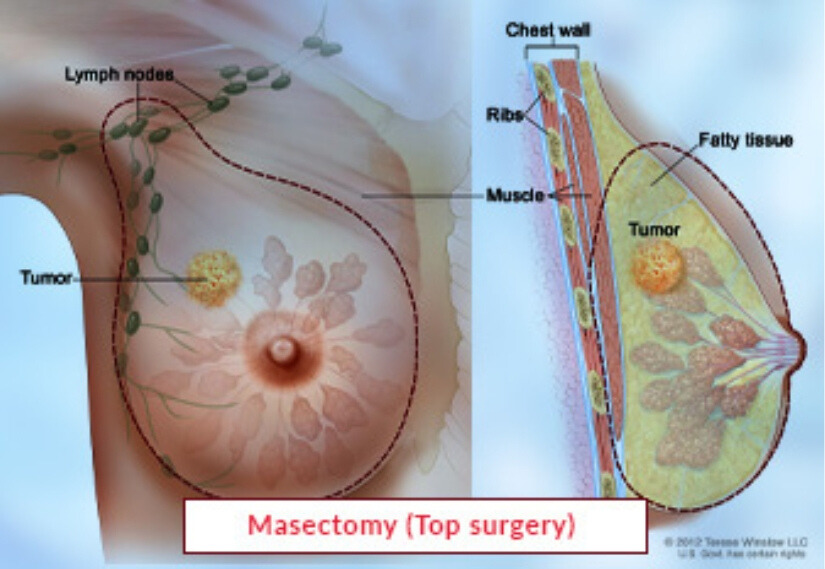Mastectomy lebanon