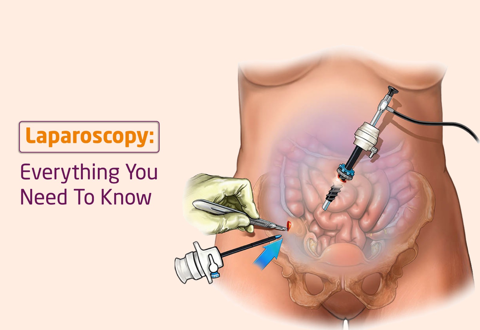 Minimally Invasive Surgery