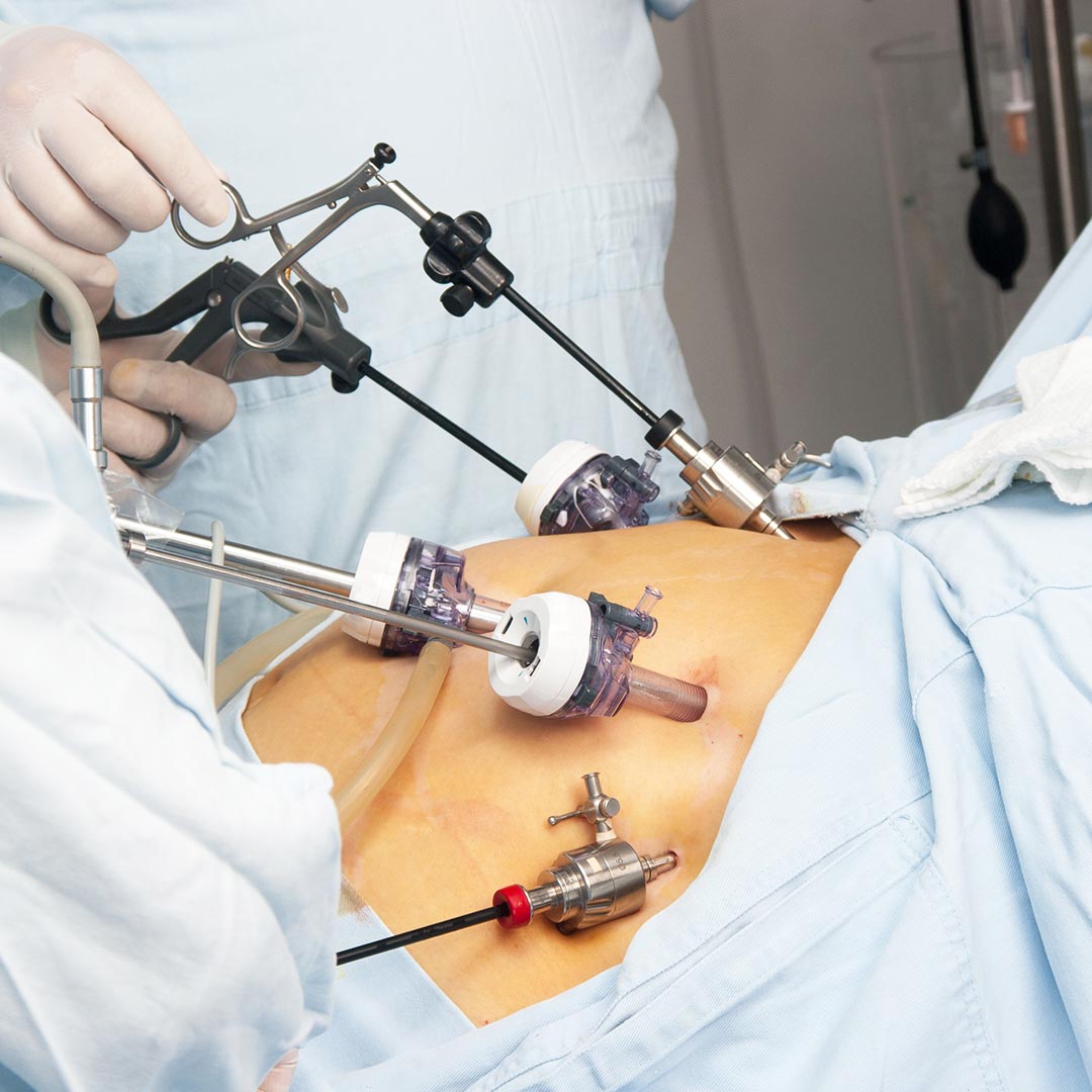 Endometriosis Surgery