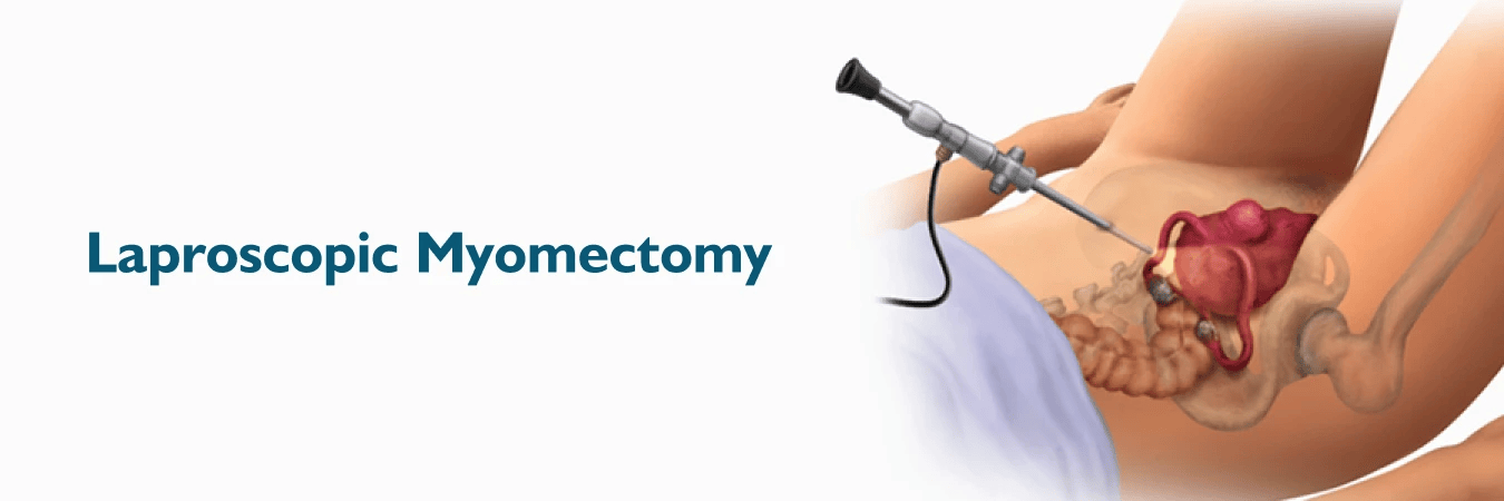 Laparoscopic Myomectomy Lebanon