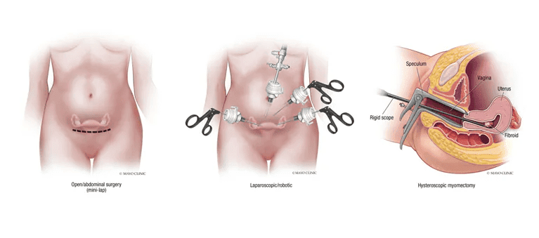Laparoscopic Myomectomy Lebanon