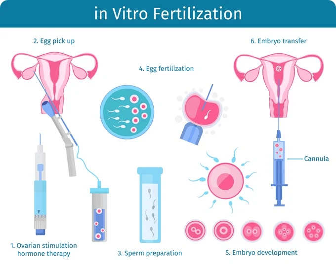 5 Stages of IVF